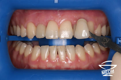 Перед процедурой аппаратного отбеливания зубов системой ZOOM 4