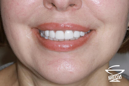 После лечения лечения