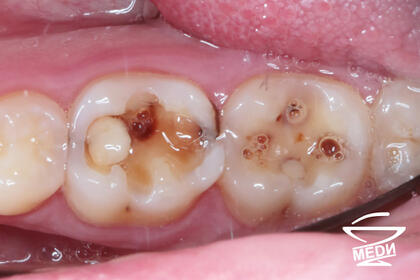 До начала лечения