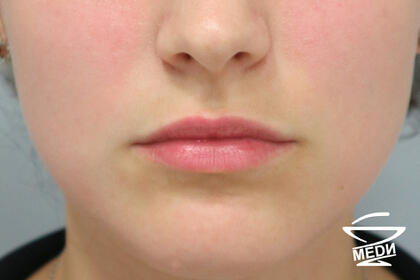 До начала лечения