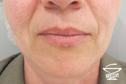 До начала лечения