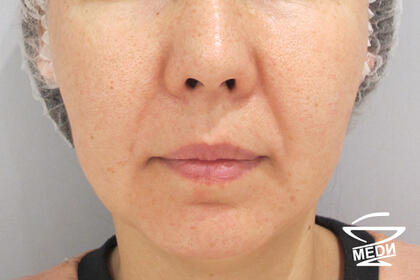 До начала лечения