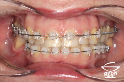 До начала лечения