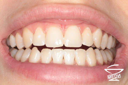 В процессе лечения