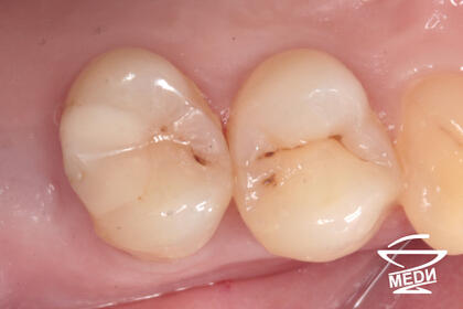 До начала лечения