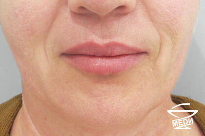 После выполнения плана лечения