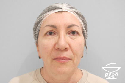 До начала лечения