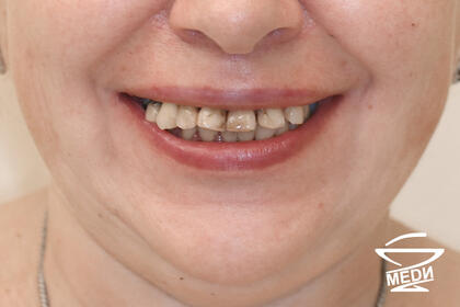 До начала лечения