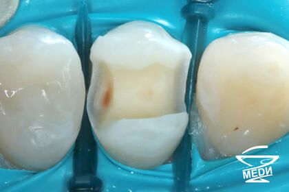 В процессе лечения