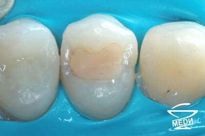 До начала лечения