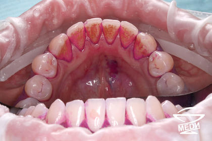 Перед процедурой профессиональной гигиены полости рта
