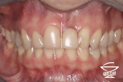 До начала лечения