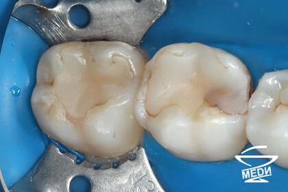 До начала лечения