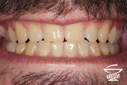 Перед процедурой профессиональной гигиены полости рта