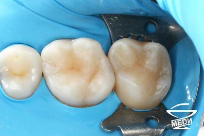 После лечения лечения