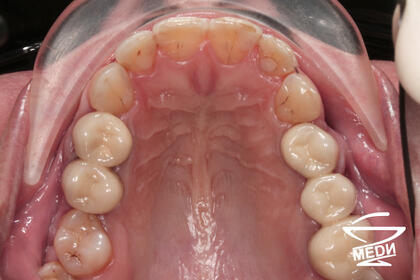 До начала лечения