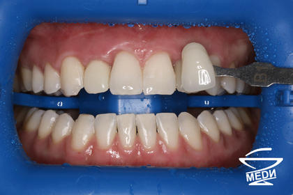 После процедуры аппаратного отбеливания зубов системой ZOOM 4