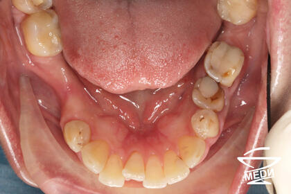 До начала лечения