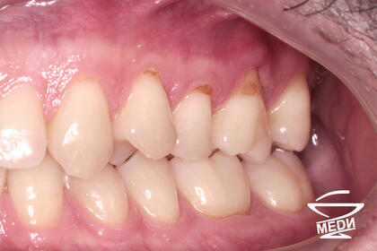 До начала лечения