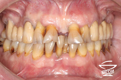 До начала лечения