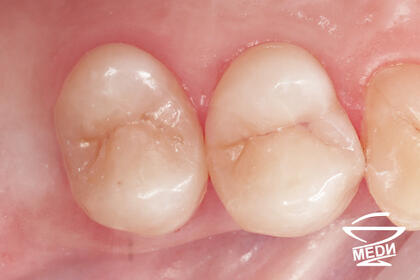 После выполнения плана лечения