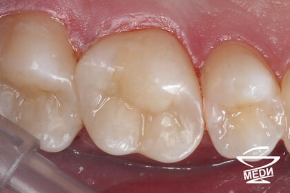 После лечения лечения