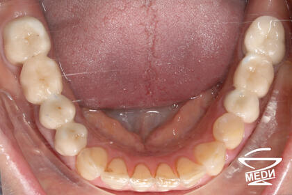 До начала лечения