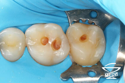 В процессе лечения