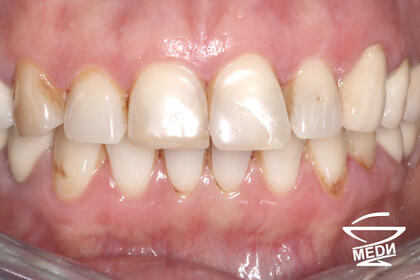 До начала лечения