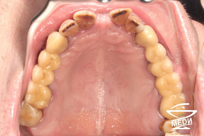 До начала лечения