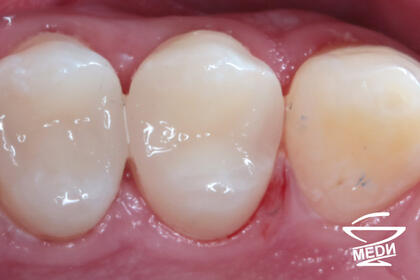 После лечения лечения