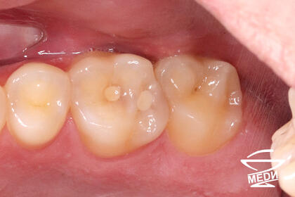 До начала лечения