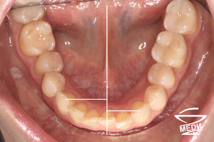 До начала лечения