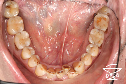 До начала лечения