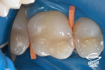 До начала лечения