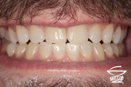 После процедурой профессиональной гигиены полости рта