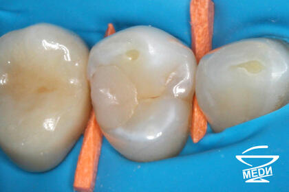 До начала лечения