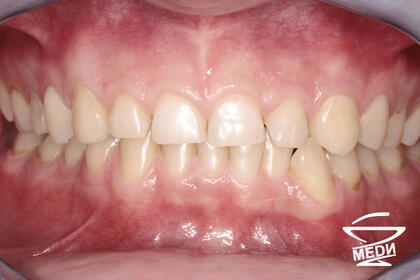 До начала лечения