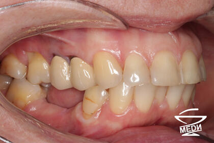 До начала лечения