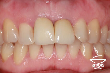 До начала лечения