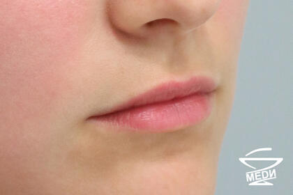 До начала лечения