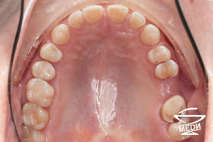 До начала лечения