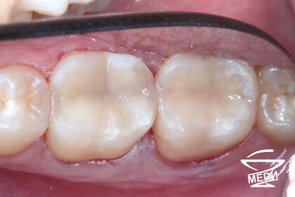 После лечения лечения