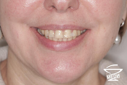 До начала лечения