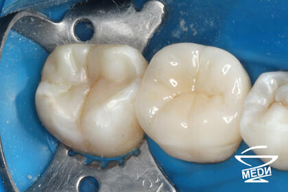 После выполнения плана лечения