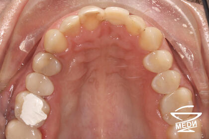 До начала лечения