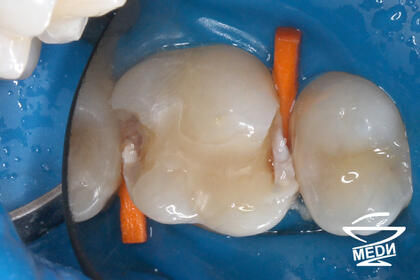 В процессе лечения